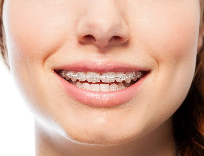 Teen braces patient smiling at Orthodontics in Woodland Hills
